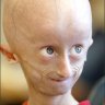 Chico Progeria